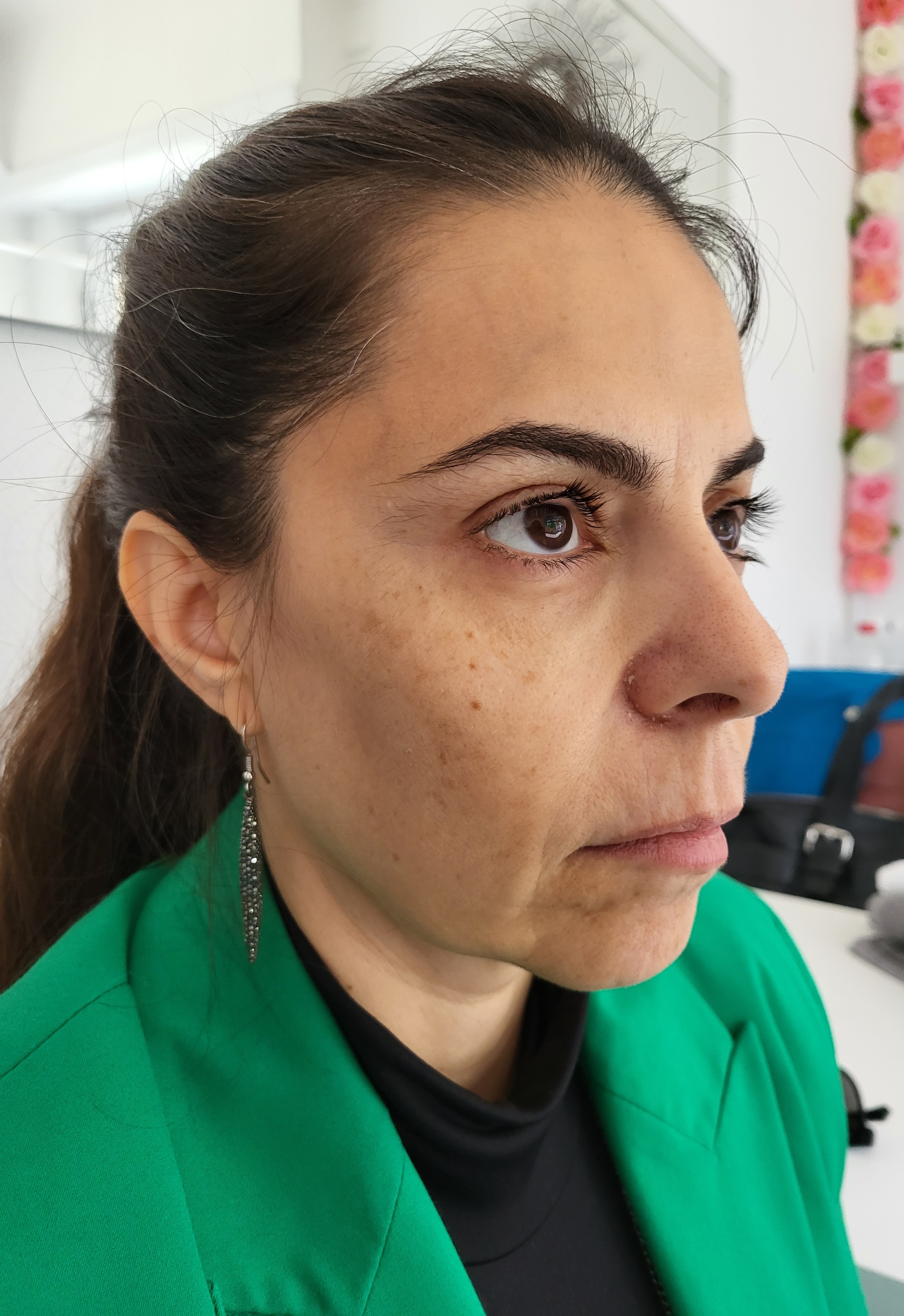 Harmonização Facial Antes